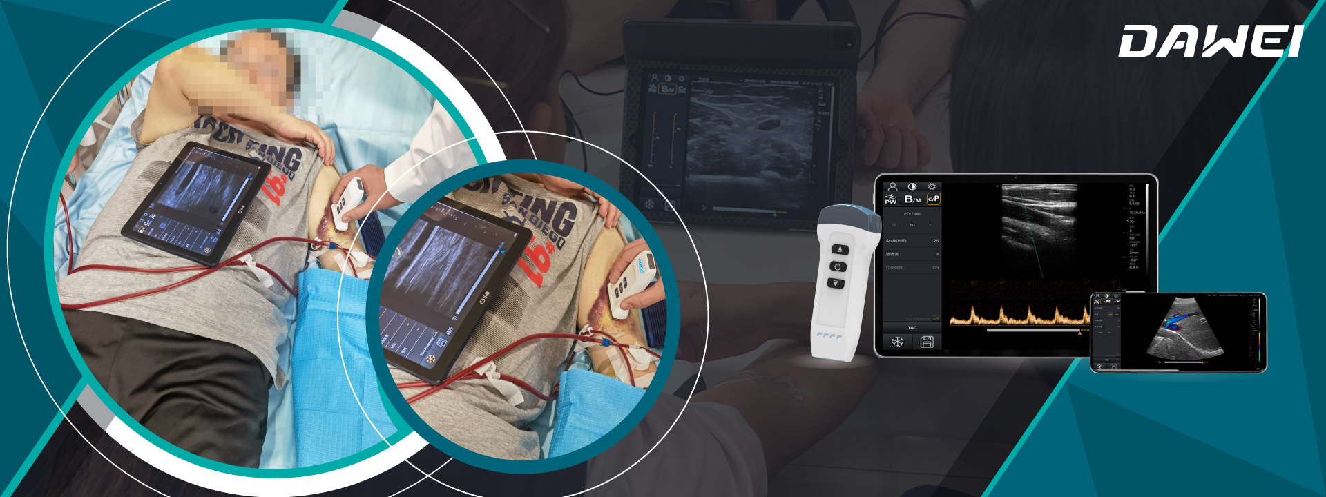 Melhorando o diagnóstico renal O papel dos scanners de ultrassom sem fio na nefrologia